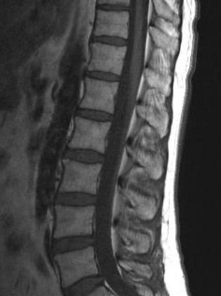 Human Spine Vertebrae